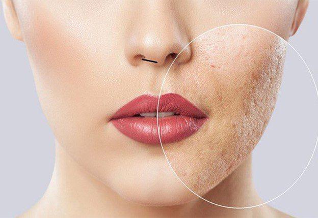 نحوه تزریق مزوتراپی صورت